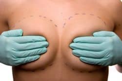 ist 5114116 250w breast implants