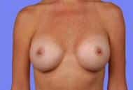 Saline Breast Implants with Unequal Fill