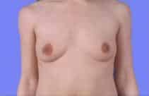 Natural Looking Breast Augmentation for 29 Year Old Women