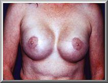 Breast Implants After Bilateral Mastectomies for Breast Cancer
