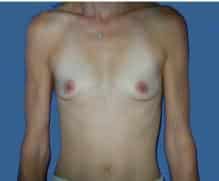 Gummy Implants Used Breast Enlargement Surgery