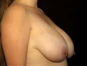 Woman Receives Breast Reduction