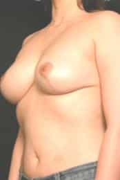 Woman Seeks Breast Reduction
