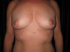 OKBoobies Breast Augmentation Photos