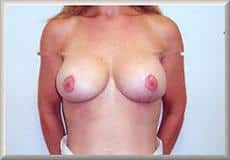 Mastopexy and Breast Augmentation Revision