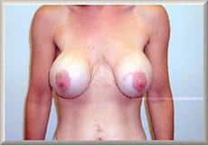 Mastopexy and Breast Augmentation Revision