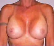 Breast Augmentation Revision Surgery