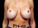 RD’s Breast Augmentation Revision