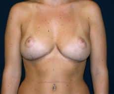 Correcting Droopy Breasts (Grade 2 Ptosis) with Lift & Implants